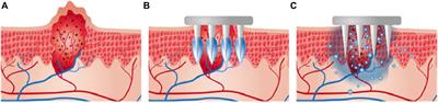 Microneedle-mediated drug delivery for cutaneous diseases